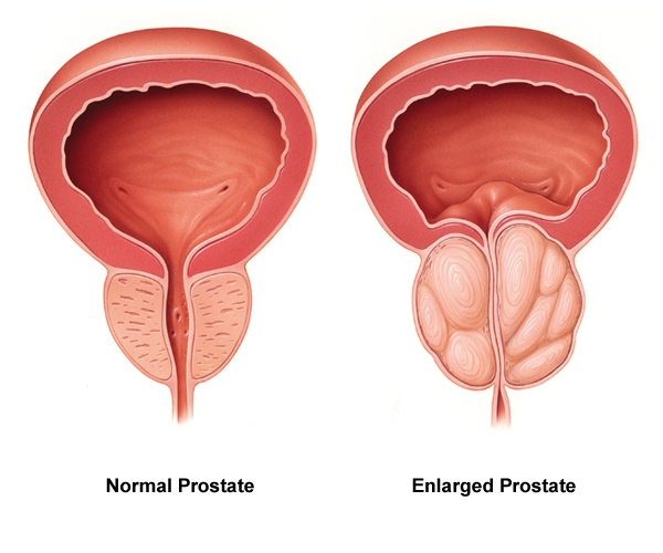 Fluxactive Complete Prostate Health
